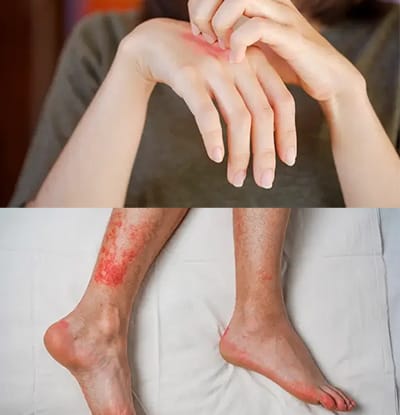 bed bugs bite Are bed bug bites dangerous